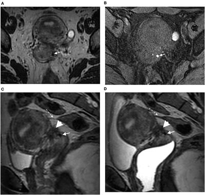 Value of 3D MRI and Vaginal Opacification for the Diagnosis of Vaginal Endometriosis